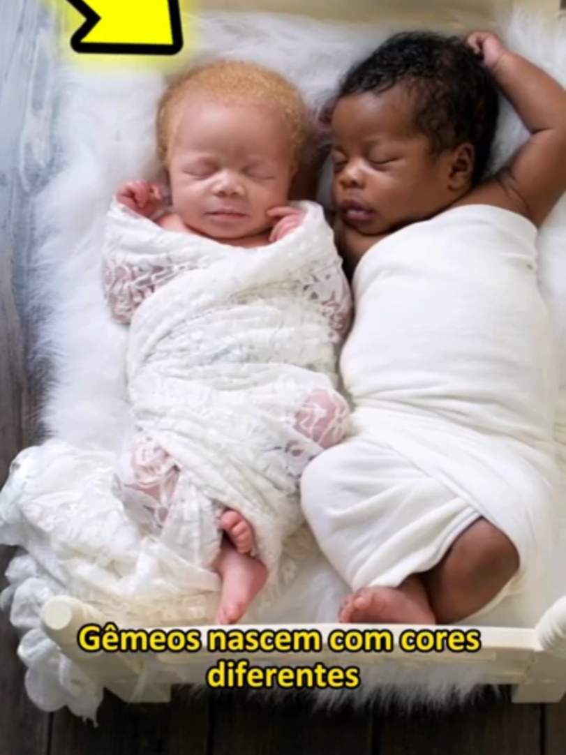 GÊMEOS nascem com CORES DIFERENTES, e como eles estão... #bebe #viral #short #videoviral