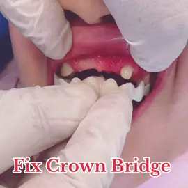 ✅Free Consultation  ✅Free Registration  ✅On Promo ✅Installment Basis ✅Kabayan Offer Direct Message po mga Kabayan For 🇰🇼 Kuwait Only…. All Dental Services Available  Salmiya Blck 2,Hamad Mubarak St. B Clinic .. #everyone #kuwait🇰🇼 #fyp #fypageシ #legit💯 