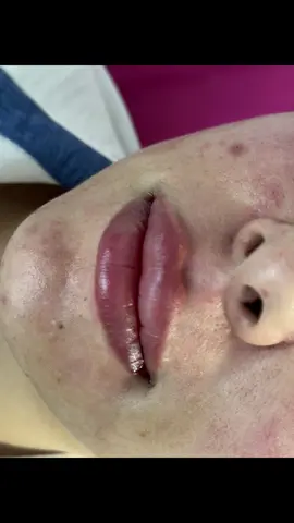 Lip filler Botox  Skin booster  Eye booster #hydrafacial #dr_nouran_gehad #fyp #تجميل #الوطن_العربي 