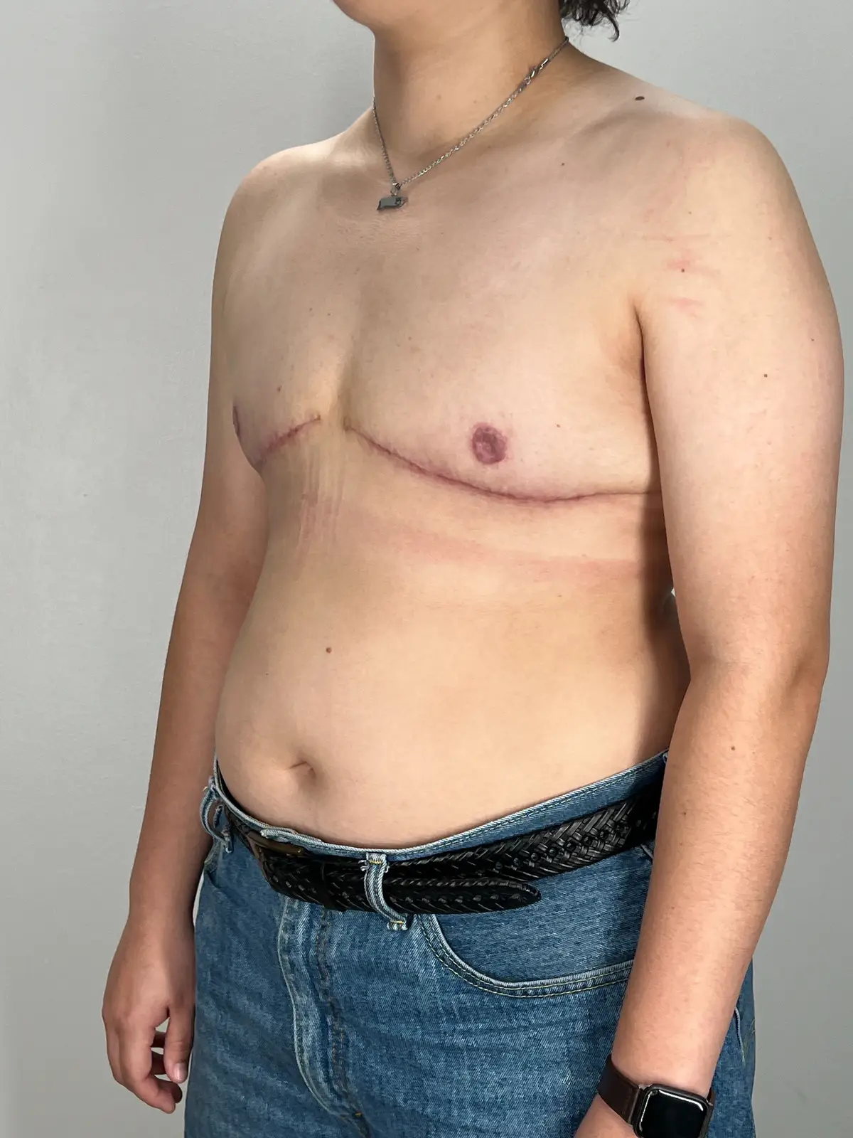 Look at those incisions 🔥 Dr. Afshari performed an FTM top surgery on our beautiful patient to achieve this masculine result. Results are 3 months post-op!  #surgerytok #topsurgery #plasticsurgerytok #transman #ftmtop    