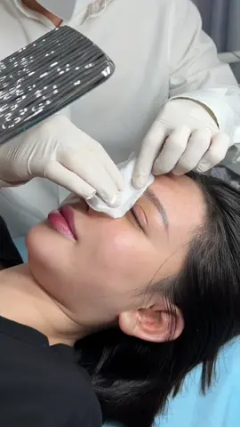 Mũi + mí trung hoa ✅ #nangmuisualai #nâng_mũi_cấu_trúc_đa_tầng #muitrunghoa #xuhuong #suamuihong #viralvideo #taohinhdouyin 