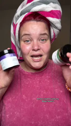 Thighs looking a little crusty and inflammed? I feel that! Grab some MyMagicHealer Flare Care, sis! You’ll thank me later! @mymagichealer_usa @MyMagicHealer #hidradenitissuppurativa #hidradenitissuppurativawarrior #hs #boil #cyst