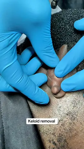 Keloid removal #keloidremoval #keloid #earkeloidremoval #foryou #classicskintherapist 