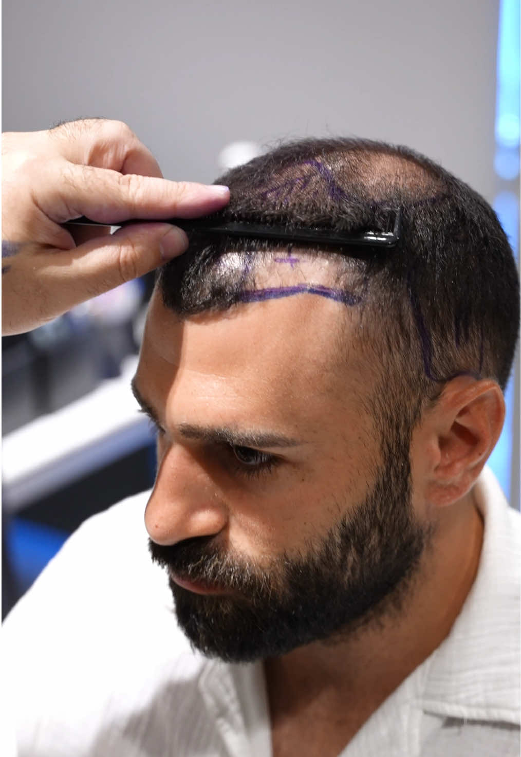 The journey to a natural result begins with understanding each patient’s unique needs. Dr. Acar and his medical team carefully analyze the top frontal and crown areas, ensuring the hairline design respects both natural flow and density. This precise planning led to professional operation for natural results. You can contact us to schedule an appointment at Cosmedica Clinic. For Online Consultation 👇🏽 📱+904444267 Whatsapp ✉info@cosmedica.com 🌐www.cosmedica.com . . . #hair #hairtransplant #greffedecheveux #hairtransplantation #hairanalysis #fue #dhi #dhisaphhire #hairline #hairloss #hairrestoration #transplantecapilar #beardtransplant #hairlosstreatment #menshair #hairtransplantturkey #istanbul #turkey #usa #uk #canada #france #germany #italy #spain #reels #reelsviral #cosmedicaclinic #drleventacar #dracar