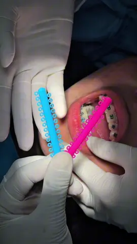 Best combo🦷✨ #brightsmiledentalhospital #brace 