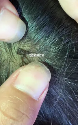 #tiktokindia_ #lice #omg #removalice 
