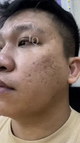 Cập Nhật Da Sẹo #chamsocdamun#chamsocdanam #chamsocseo#lequynhspa#hocnghespa