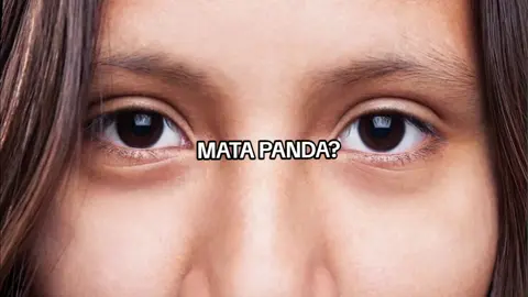cape ga sih sama mata panda?mau sampai kapan didiamkan,lebih baik rawat kembali#fyp #matapanda #theoriginote #perawatan #skincare 