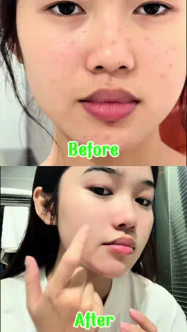 Dùng gần hết tuýp luôn rồi #gelchammun #lorsia #giammun #munsung #munviem 