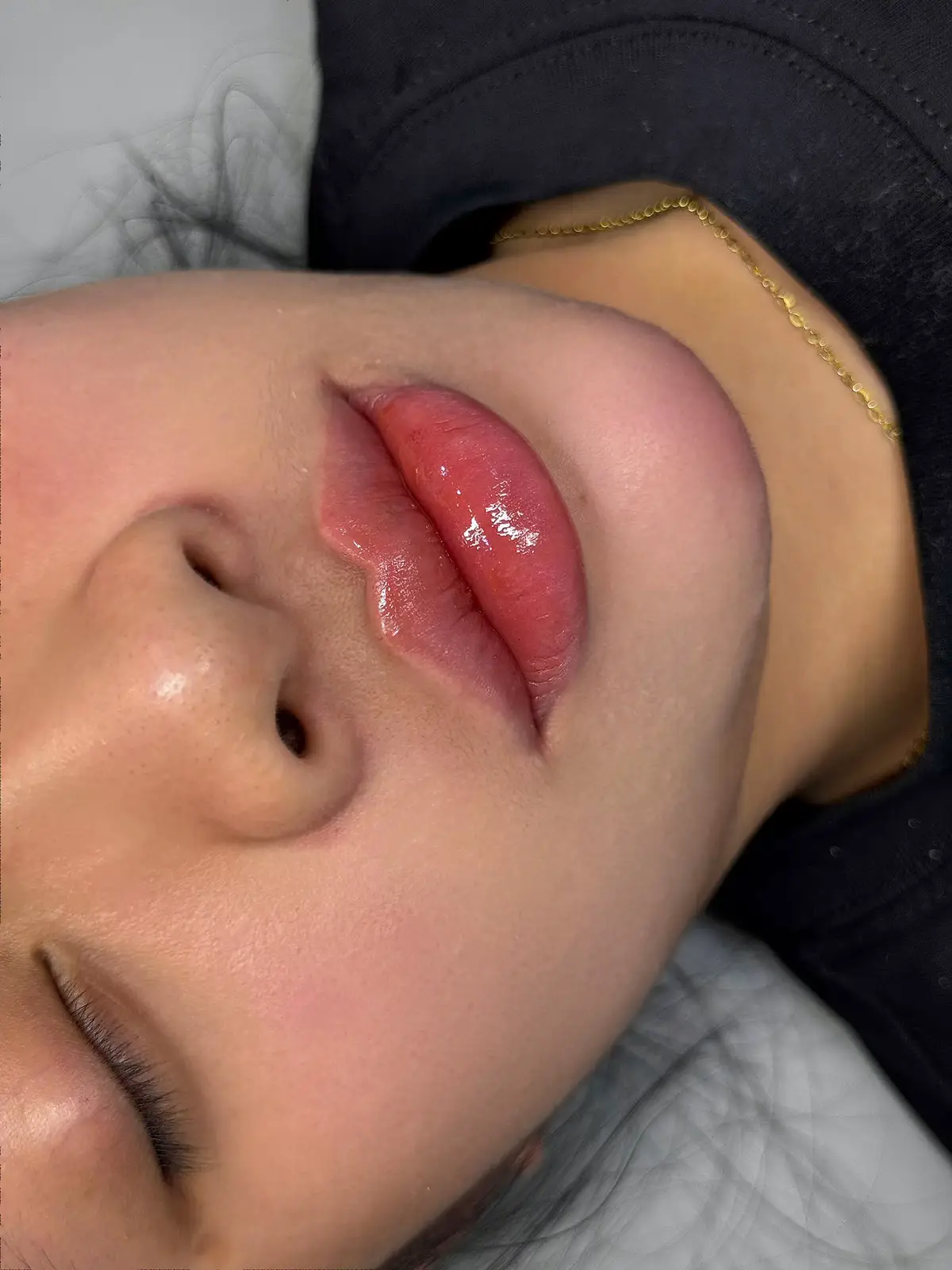 Căn chỉnh lại dáng trên nền môi dày,đã tiêm filer👆 #filer #tiêmmôi #CapCut #xuhuong #tunhien 