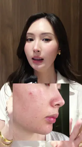 Vết thâm sau mụn là cái cái nhức nhối chắc là nhiều chị em phải đau đầu. #ekseption #niacinamide #skincare #acnescar #mụn 