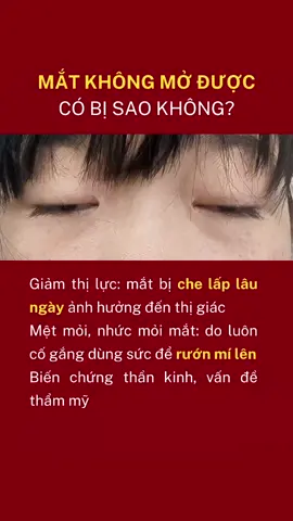 mắt không mở được #xuhuong #trending #supmi