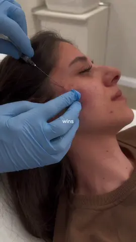 ✨ Say goodbye to acne scars with *subcision treatment*!   This simple, minimally invasive procedure breaks the fibrous bands under the skin that cause deep scars — leaving your skin smoother and more even 💫   🎯 Best for rolling scars   ⏱️ Quick recovery   💉 Can be combined with PRP or filler for even better results   Ready to start your skin transformation? 🌟   #Subcision #AcneScarTreatment #SkinCareTikTok #BeforeAndAfter #Dermatology 