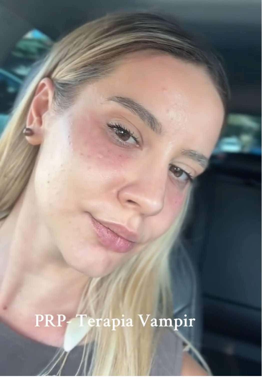 ✨ Astăzi nu am făcut JALU Pro, ci terapia Vampyr (PRP) 🩸 Cele două fac echipă super bună împreună și rezultatele se completează perfect 💉✨ #skincare #beautytherapy #GlowUp #PRP #JaluPro 
