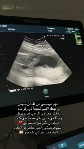 فقدت صغيري قبل أن أراه، لكني مؤمنة أن الله اختاره لي شفيعًا ينتظرني في الجنة 🤍 اللهم عوضني عوضًا جميلًا، ينسيني مرارة الفقد ويملأ حياتي فرحًا وخيرًا .. #اكسبلور #fyp #ولادة #فقدان #جنيني 