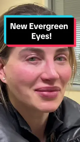Evergreen is another popular color. Its a quick and easy trip to our Beverly Hills office for the ColorEyes procedure. More info at MyColorEyes.com #coloreyes #eyecolor #keratopigmentation #flaak