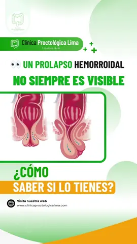 🔍 Un prolapso hemorroidal no siempre es visible, pero sus síntomas sí se notan. Si sientes dolor, bultos o molestias, ¡es hora de actuar! Si llevas tiempo con molestias anales, no esperes más. Agenda tu cita hoy 📲 921 550 391 #hemorroide #salud #cuidado #bienestar #clinica #prevencion #fyp #bhfyp #fypシ #follow
