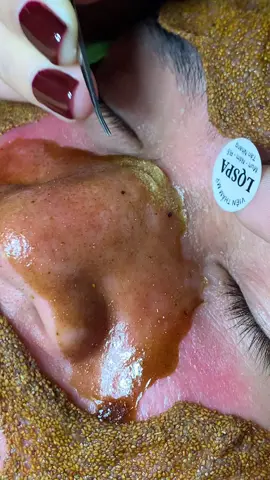 Phê chưa #chamsocdamun#chamsocdanam#chamsocdaseo#lequynhspa#hocnghespa 