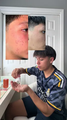 Así se ve su rutina de noche ✨ Después de la ducha, un poco de cuidado personal para terminar el día con piel fresca y saludable 😴💧 #NightRoutine #SkincareForHim #acne #beforeandafter @Viyant Beautyy 