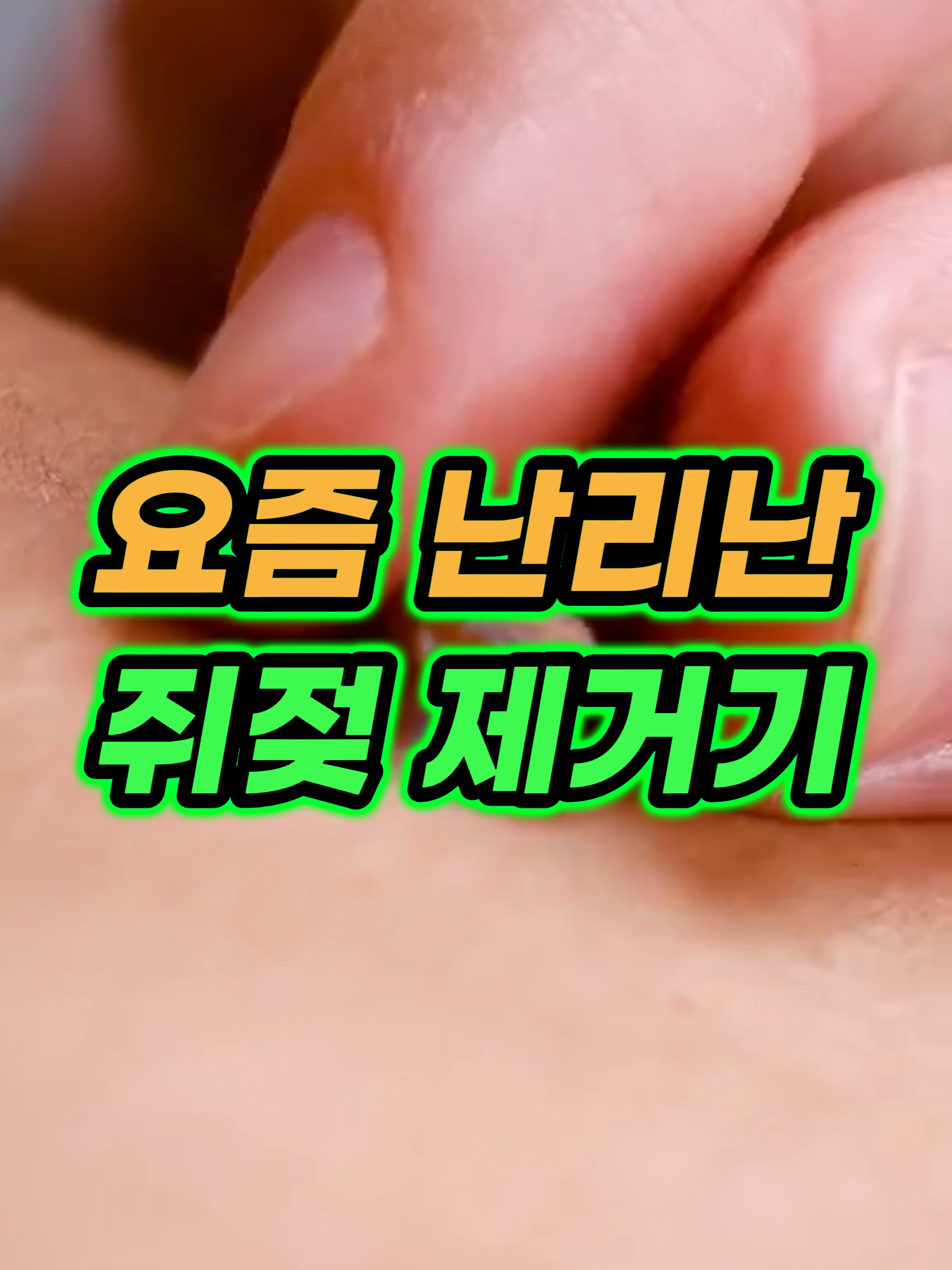 🔥0684번 구매 : 쥐젖 제거기  / 자세한 상품은 프로필 링크를 확인하세요 #쥐젖제거기 #쥐젖제거 #쥐젖제거꿀템 #쥐젖 #5초쇼핑