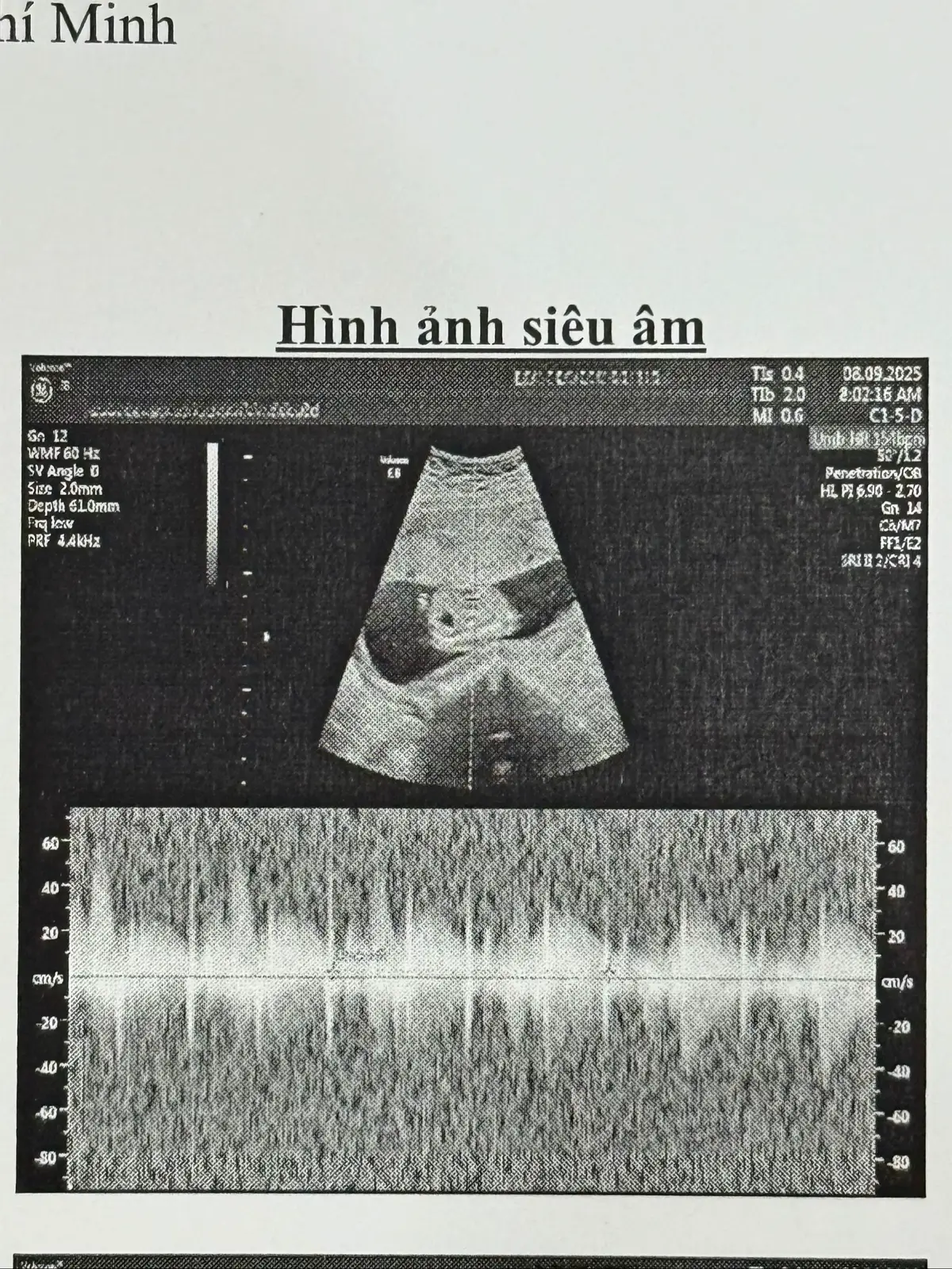 Mỗi lần siêu âm là mỗi lần hồi hộp.  Thêm một nhịp tim, thêm một cuộc sống. Chúng ta sắp có thêm một thành viên mới. 👣 #embe #mebau #mebauthongthai #mangthai 