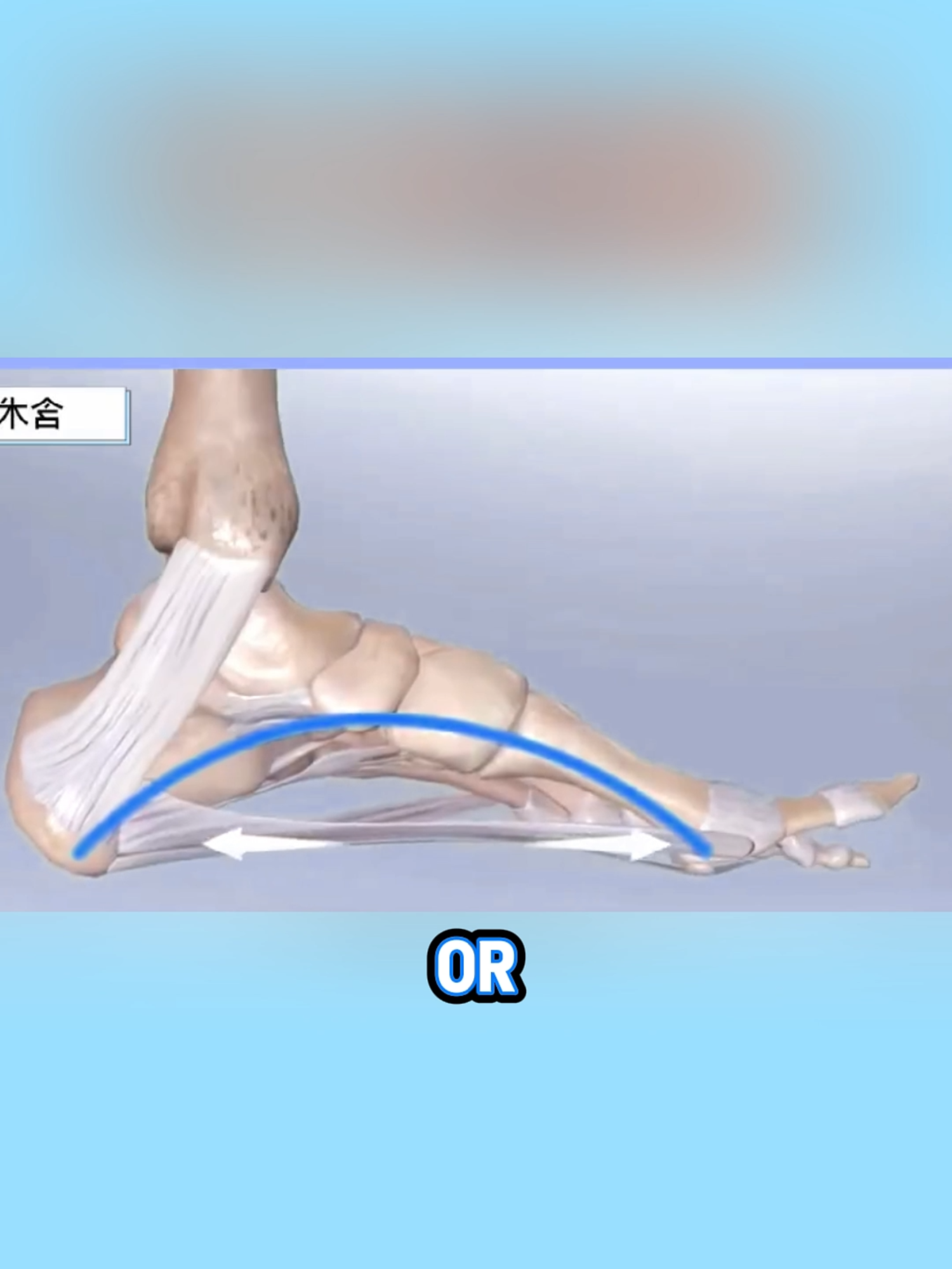 Don't let plantar fasciitis become a chronic problem! Wearing the right insoles can relieve pain and prevent it from coming back.#CloudInsoles #ComfortInsoles #AffordableFinds #SportsAccessories #RelieveFootPain#FootHealth#ShopVideoCarnival#dealsforyoudays#videowave#TikTokShopBacktoSchool#RushReady2025