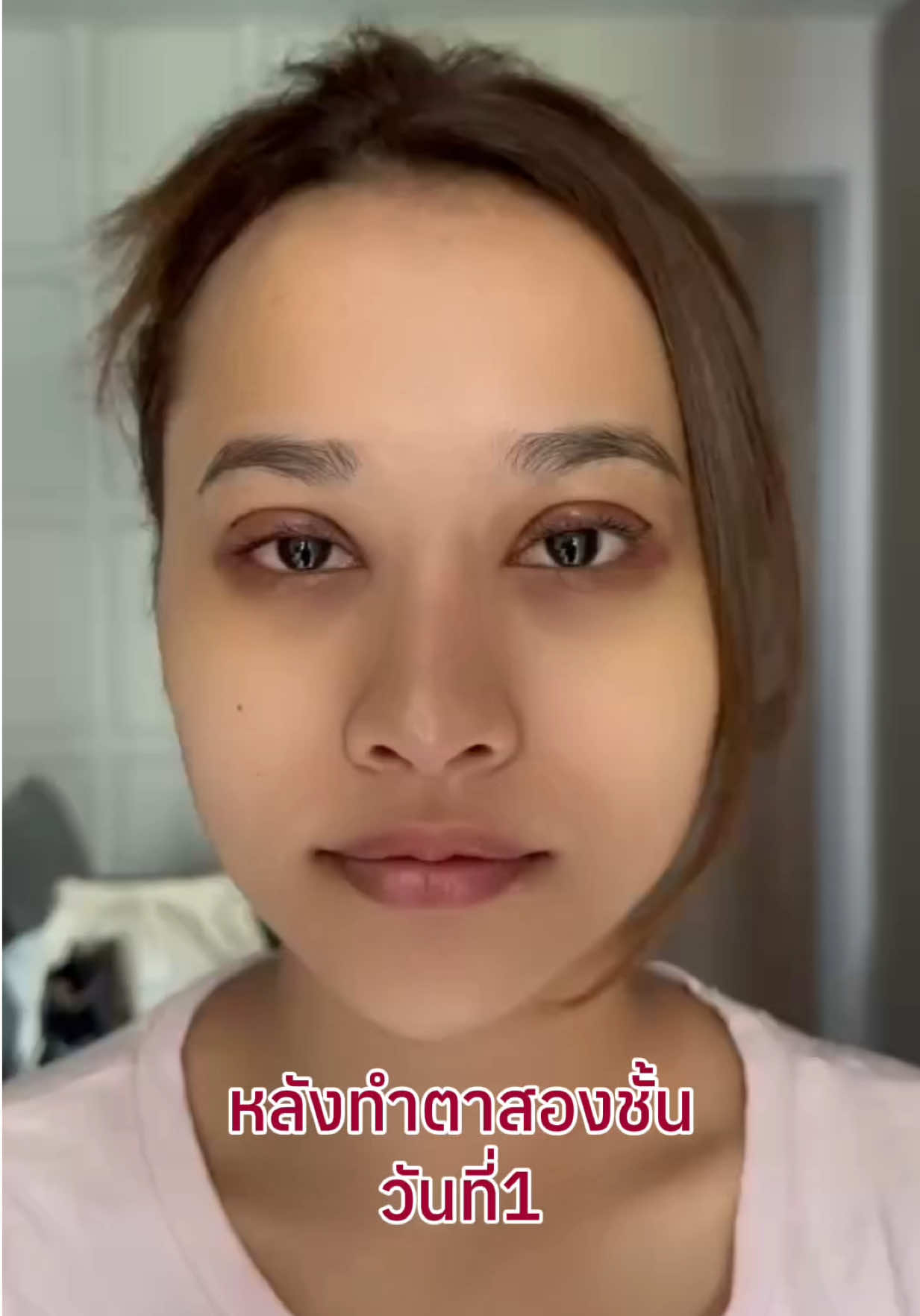 ทำตาสองชั้น บวมช้ำน้อยแผลเนียนต้อง ที่นี่เลย ✨ #ตาสองชั้นsky9 #ตาสองชั้น #รีวิวตาสองชั้น #sky9eyeclinic #ทําตาสองชั้น 