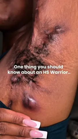 #foryou #scar #operation #stretchmarks 