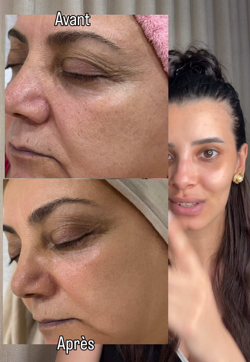 ✨ Marre des taches pigmentaires et des cernes qui résistent au maquillage ? J’ai fait tester à ma mère le Retinal Shot Booster 0,1 % de @celimax.global et les résultats sont bluffants 🤯 ✅ Estompe les taches et l’hyperpigmentation ✅ Améliore l’apparence des cernes et des pores ✅ Rend la peau plus lisse et lumineuse Et le tout pour seulement 8 € sur @YesStyle ! 🌸 Franchement, difficile de trouver mieux en rapport qualité-prix. #celimax #retinalshot #skincare #yesstyle #hyperpigmentation  