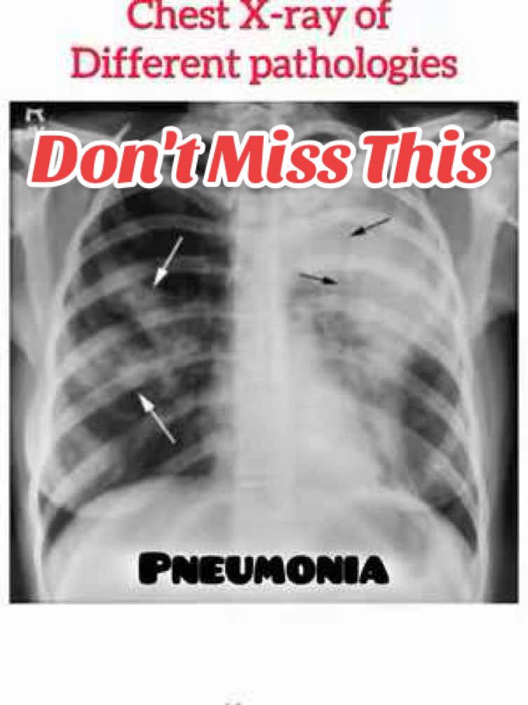 Chest X-ray interpretation| Chest x-ray of different lung diseases|  . . . . . #docsaqi #healthverse  #LungXray #Pulmonology #MedicalEducation #HealthEducation #LungHealth #RespiratoryHealth #COPD #Pneumonia #TB #Emphysema #PulmonaryEffusion #PulmonaryFibrosis #XrayFindings #LungDiseases #Radiology #MedicalImaging #Healthcare #Medicine #Nursing #MedicalStudents #HealthScience #LungFunction #Breathing #RespiratoryCare #PulmonaryMedicine #LungXrayImages #MedicalStudents #NursingStudents #HealthcareProfessionals #MedicalKnowledge #HealthScience #doctor #nurse #pulmonologist #pulmonaryhypertension #lung #lungdisease #HealthEducation #nmu #fyp #foryouu #foryoupage❤️❤️ #doctorsoftiktok #nurselife #nursestiktok 