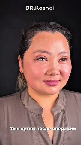 ✨ Наша пациентка обратилась с жалобами на нависшее веко, которое придавало взгляду усталость и утяжеляло выражение лица. Мы выполнили блефаропластику верхних век — деликатную операцию, позволяющую вернуть открытый и свежий взгляд. 📅 На фото — 7-е сутки после операции. Сохраняется лёгкая отёчность, что является абсолютно нормой на данном этапе восстановления. Уже сейчас заметен результат: взгляд стал более открытым, лицо выглядит отдохнувшим и гармоничным. ⏳ В ближайшие недели отёк уйдёт полностью, а швы станут практически незаметными. Для записи :0705 688 779 #блефаропластикавек #бишкек #блефаропластика 