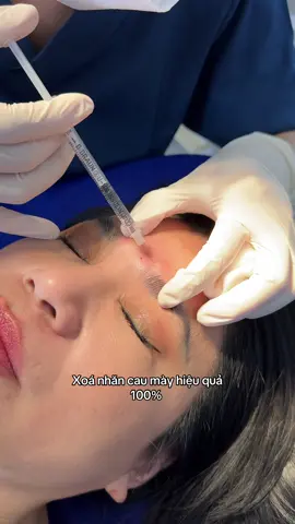 [Trực tiếp]: Xoá Nhăn Cau Mày Hiệu Quả 100% #BNQ_Medical_Aesthetic #Tiểu_phẫu #Filler #Botox 