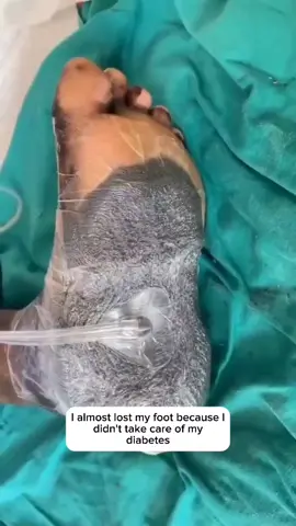 I lost my foot because I didn't take care of my diabetes #diabetes #hospital #diabetesawareness 