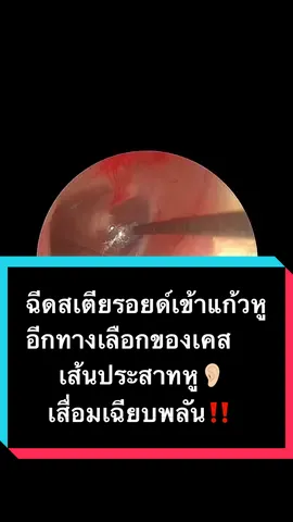 คนไข้ที่เส้นประสาทหูเสื่อมเฉียบพลัน(หรือหูดับเฉียบพลัน) การรักษาหลักคือใช้สเตียรอยด์รักษา ในเคสนี้เลือกฉีดสเตียรอยด์เข้าแก้วหูเพื่อช่วยลดภาวะอักเสบของเส้นประสาทหู #tiktokสายความรู้ #tiktokuni #รู้จากtiktok #หูดับ #hearingloss 