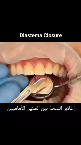 اغلاق الفتحة بين السنين الأماميين  #سامرعقاد #SamerAkkad  #tandläkare  #dental #dentist