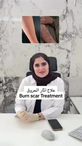 Before and after Burn Scar Treatment  قبل وبعد علاج آثار الحروق مع اخصائية البشرة هلا 💞💖 @SP .hala Mahfouz  #explore #viral #scarremoval #علاج_آثار_الجروح_الحروق_الندب #التقشير_البارد 