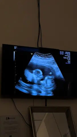 Growing big and strong🥹🩵 #15weekspregnant #babyboy #baby2 #ultrasound #fyp 