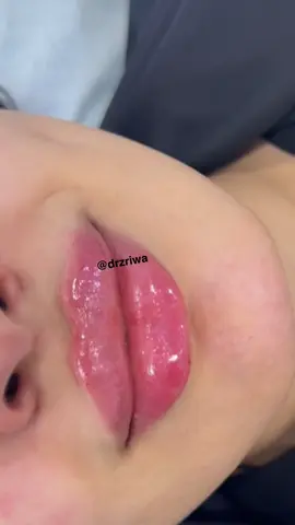 🥰💉👄 #فيلر #فيلر_الشفايف #دكتورة_زريوه #drzriwa #عيادات_تجميل 