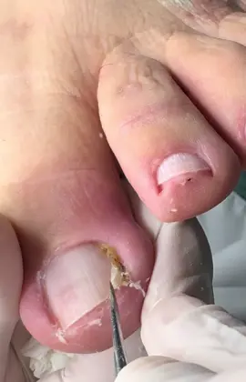 #podologa #podologia #unhaencravada #ingrownnail #unhas 