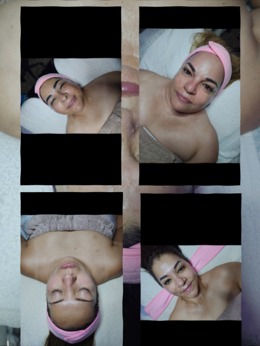 Esteticista en Denver  Faciales de hoy! Dermaplaning, microdermabrasion, enzimas y de todo un poco #facialesdelimpiezaprofunda #skincare #Esteticista #Denver #Dermaplaning 