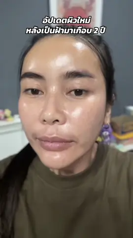อัปเดตผิวใหม่ หลังเป็นฝ้ามาเกือบ 2 ปี  ขอบคุณ @mesoestetic thailand  ที่ให้ความมั่นใจกลับมาอีกครั้ง 💕 #cosmelan #mesoestetic