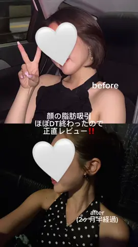 過去一の満足度💮💯‼️ クリニックは最後に公開してます🍒 #脂肪吸引 #顎下脂肪吸引 #糸リフト #大阪クリニック #美容整形