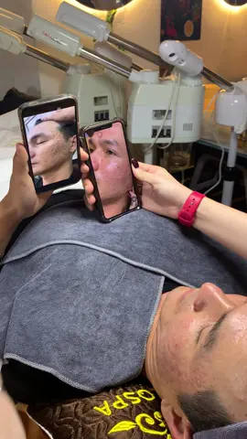 Thực tế da sẹo #chamsocdaseo#chamsocda#chamsocdamun#chamsocdanam#tanbinh      