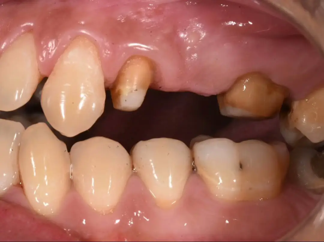 👉 Bọc chụp sứ – giải pháp thẩm mỹ và bảo vệ răng hiệu quả, khắc phục tình trạng răng xỉn màu, mẻ, mất nhiều mô răng thật sau điều trị tuỷ để đảm bảo độ bền, tránh gãy vỡ, tăng tuổi thọ răng.  #newsmile #nhakhoa #răng_sứ_thẩm_mỹ #niềngrăng #vietnam 