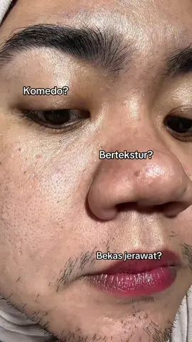 Semuanya dijamin hempas ga ada gradakan lagi #skinproblem #exfoliate #trendtiktok #eksfoliasi #skincareroutine 