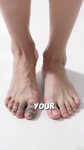 Your nails aren’t ugly-they’re just dealing with a fungal infection #antifungal #getreadyforfashionweek #nail #tiktokshop #health 