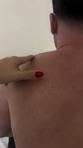 Liberação Miofascial do músculo trapézio!!! #trapezio #liberacaomiofascial #dryneedling 