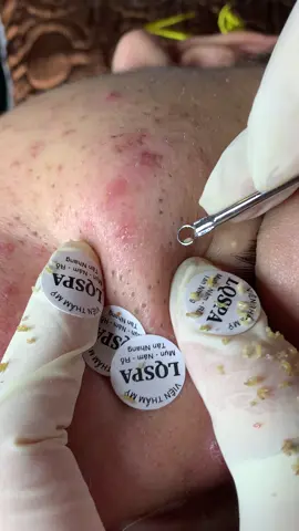 No#chamsocdaseo#chamsocda#chamsocdamun#chamsocdanam#tanbinh     