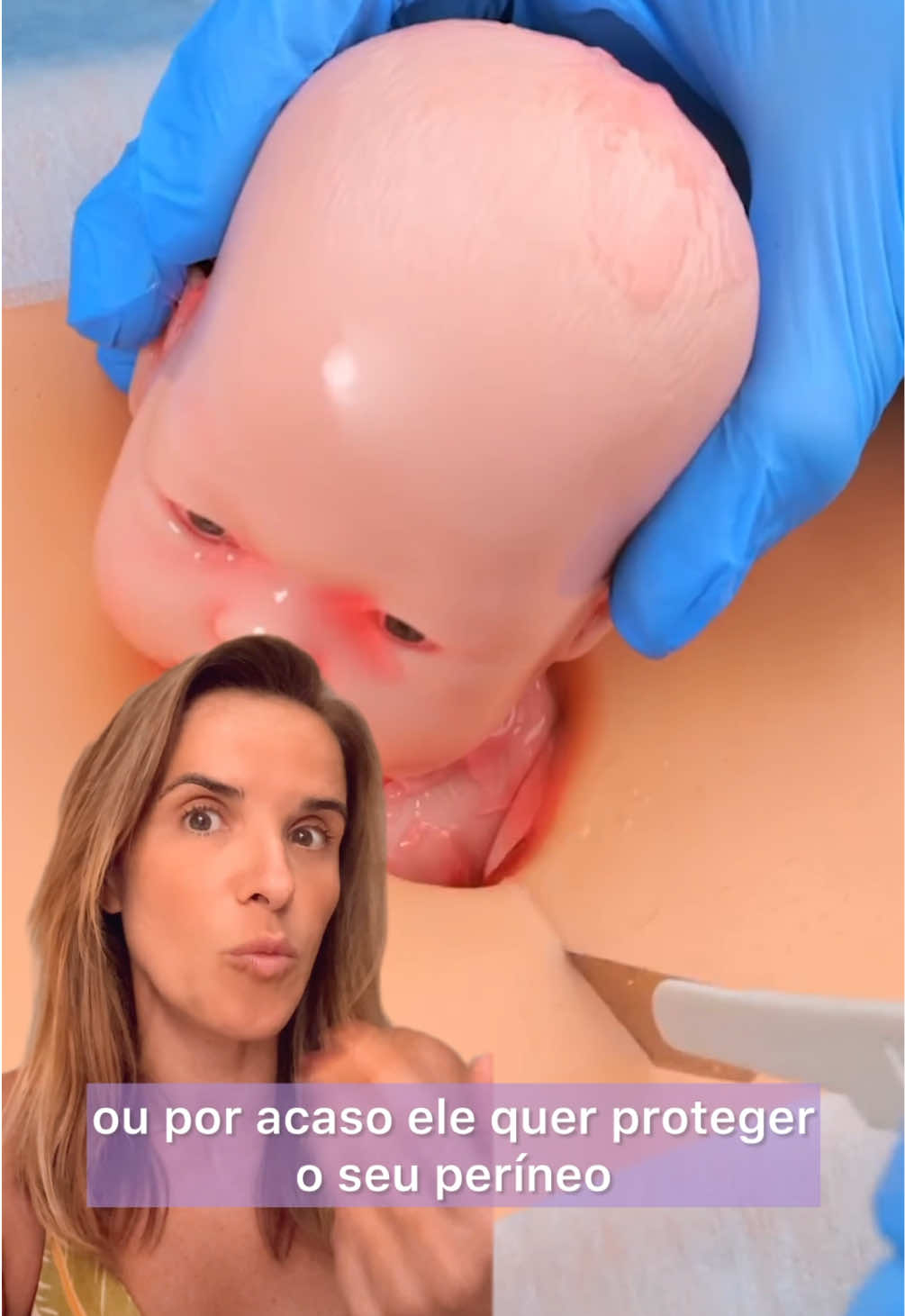 ⚡ Episiotomia realmente protege o períneo durante o parto? Pesquisas já comprovaram que esse corte não acelera a saída do bebê e não diminui riscos de laceração. Na verdade, a episiotomia aumenta a chance de traumas mais graves e prolonga o tempo de recuperação da mulher. 🌸 Hoje, profissionais de saúde que atuam com base em evidências reconhecem que não existe justificativa para realizar episiotomia. Esse procedimento é considerado uma forma de mutilação genital feminina e deve ser combatido! 🙌 Por favor, não diga que você teve uma e foi ótima. Isso é o mesmo que dizer que apanha do marido, mas é bom para se manter na linha.  É violência e não tem justificativa nenhuma.  ✅ Já me segue para saber mais sobre como cuidar da sua saúde, se proteger e se preparar para o parto.  #episiotomia #partohumanizado #violenciaobstetrica #perineoparto #laceracaoparto 