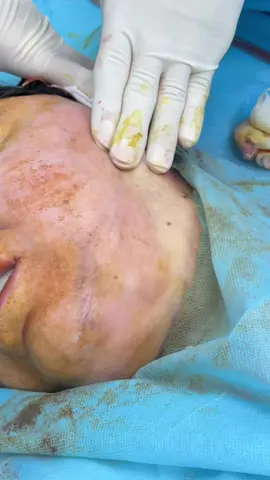 Remove Double Chin✨. #beauty #chin #nepal #foryou #fpy 